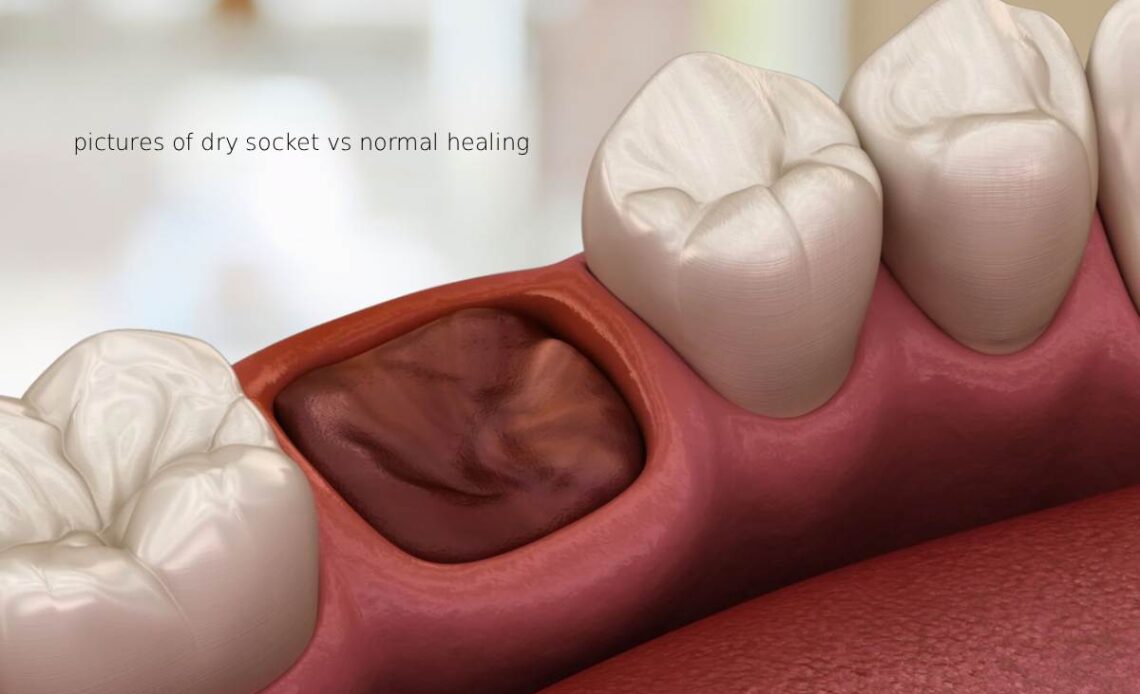 pictures of dry socket vs normal healing