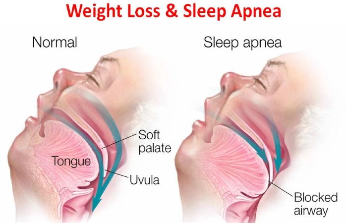 weight loss and sleep apnea